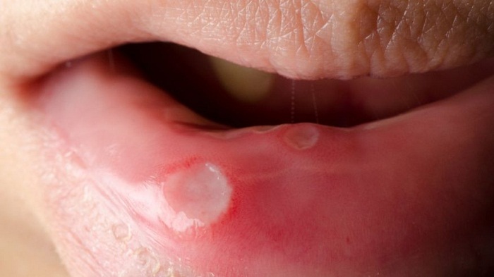 How to get rid of canker sores and prevent them from coming back